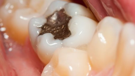 Představuje rtuť v zubních plombách zdravotní riziko?